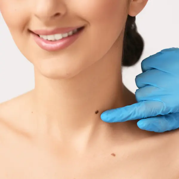 Skin Tag Removal in Dubai, Best Skin Tag Removal Dubai, al Wasl Road, UAE