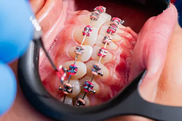 damon system braces