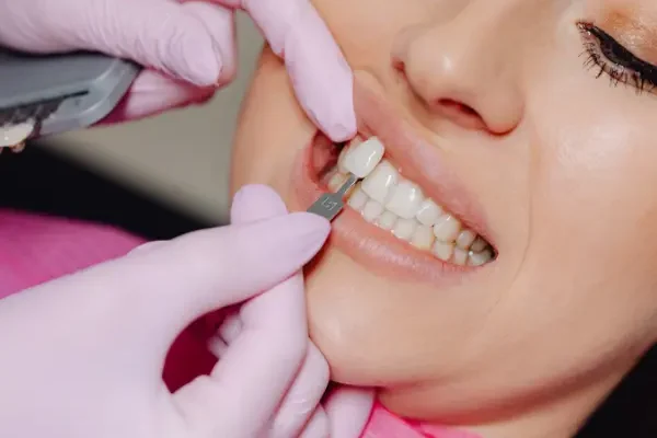 Hollywood smile with porcelain veneers in Dubai